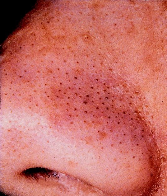 Blackhead On Back Won't Go Away Your Scalp Acne Recognizing The