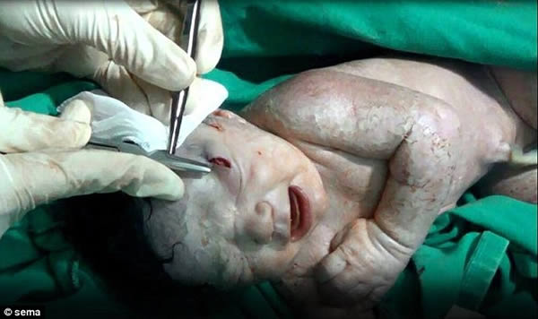 Bayi Yang Masih Dalam Kandungan Terkena Ledakkan Bom