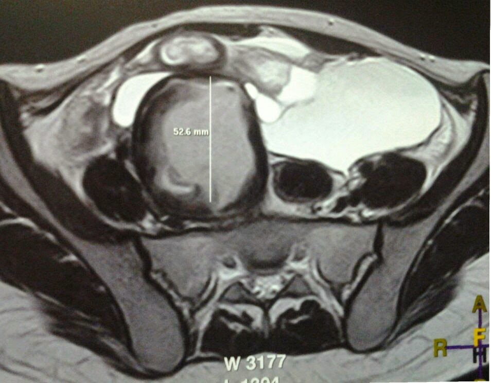 Postablation Tubal Sterilization Syndrome-a Case Report