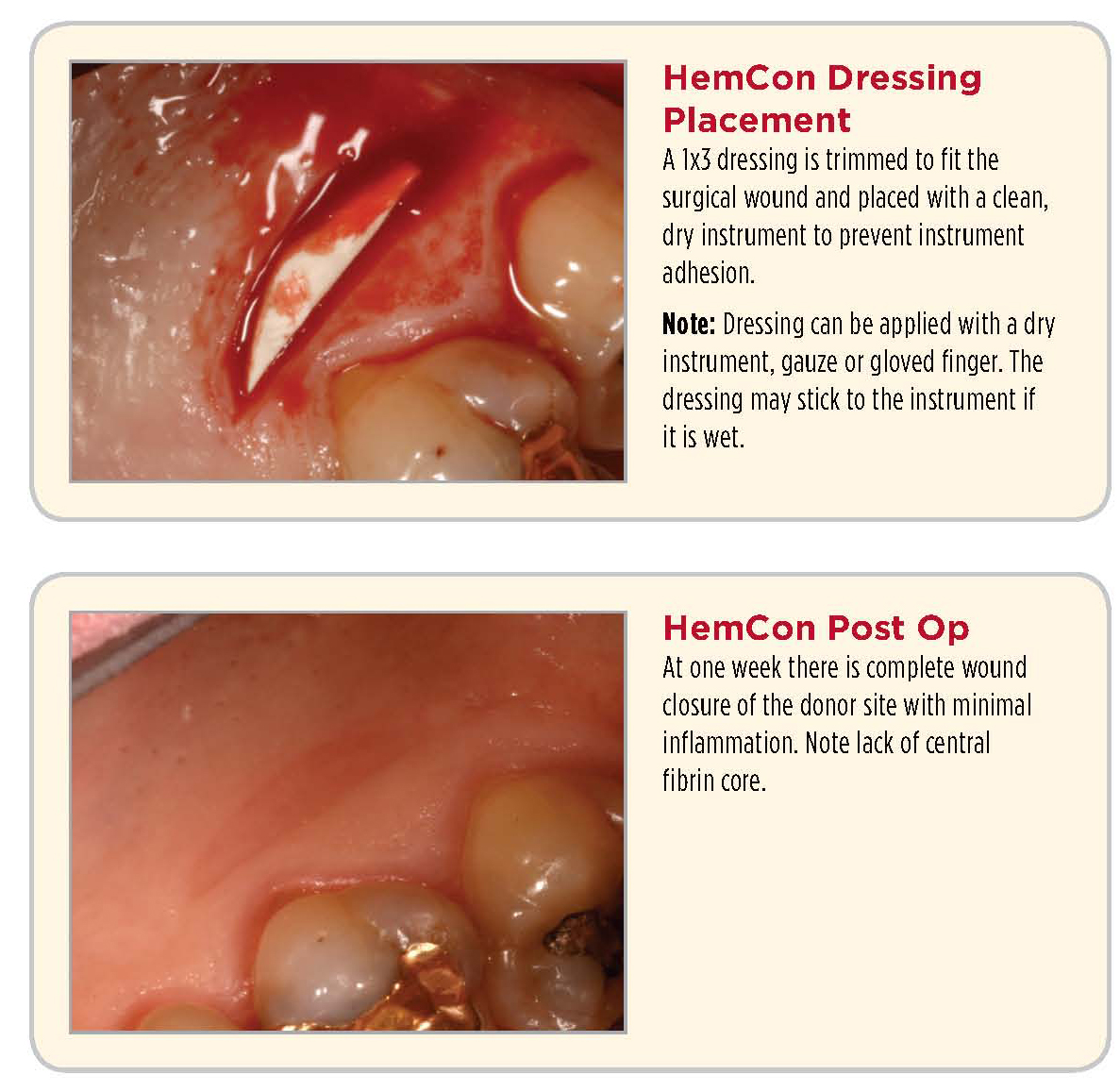 News Room ROE Dental Laboratory Hemcon Stop Bleeding the Military Way