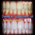Home remedies for yellow Teeth, Natural Treatment of Yellow Teeth at Home