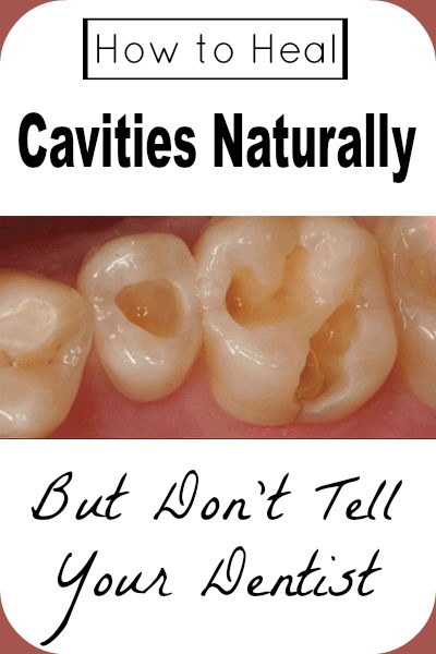 Home Remedies For Filling A Cavity Home Remedies For Filling A Cavity