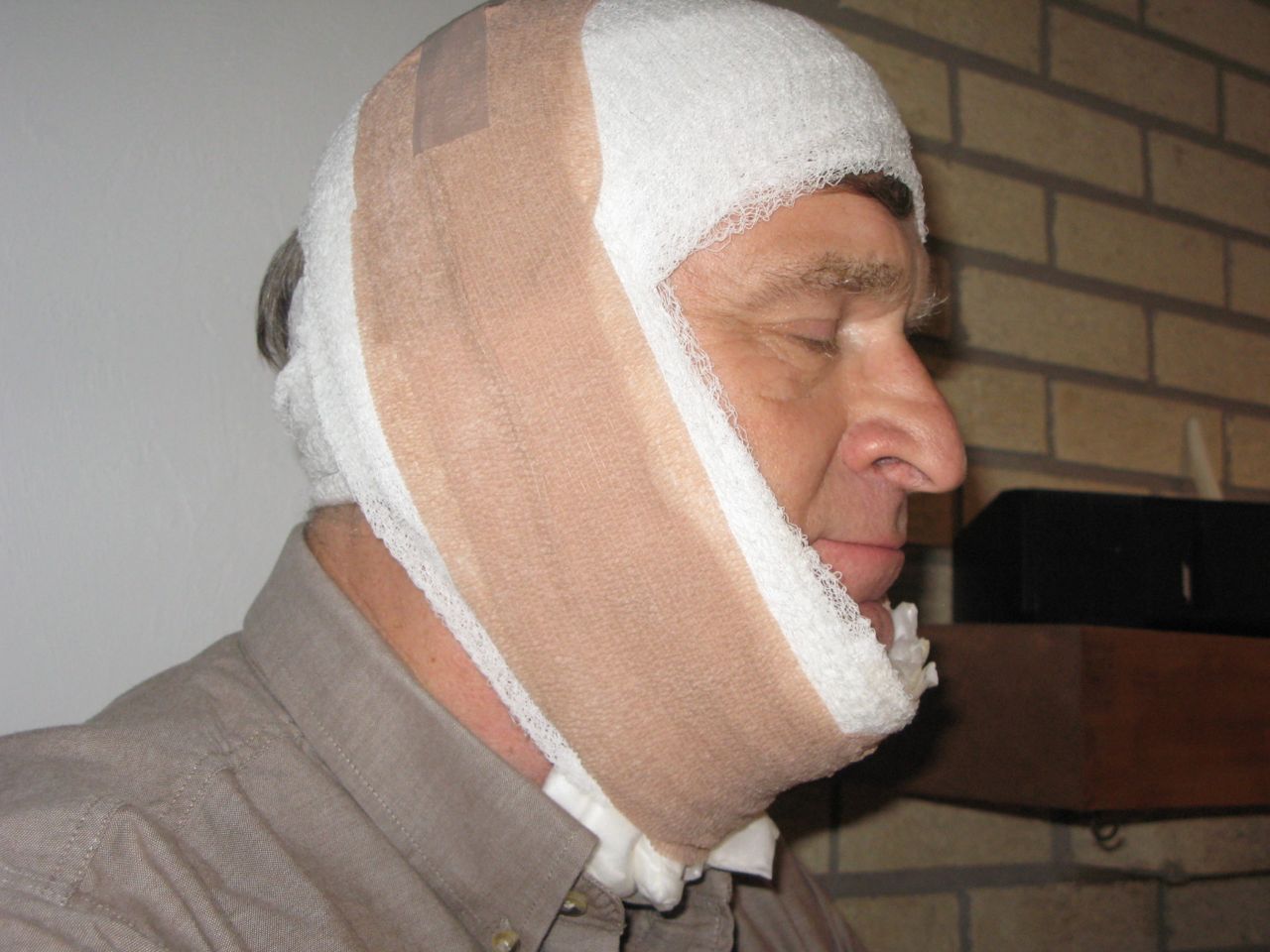 Florida Coal Cracker Chronicles Harry Has Direct Neck Lift With ZPlasty