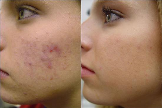 homeopathic acne treatment