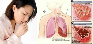 Gejala TBC Penyebab TBC Cara Mencegah dan Mengobati TBC