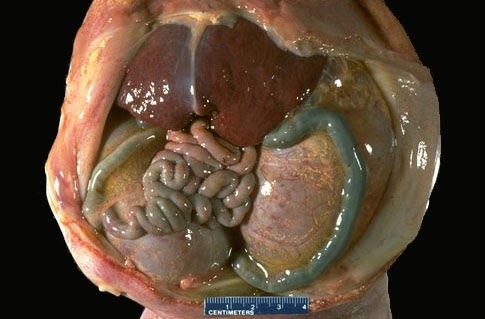 Polycystic Kidney Cyst Burst: Polycystic Kidney Disease Pictures | Best