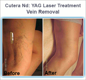 Cutera Nd: YAG laser Treatment for Veins Removal