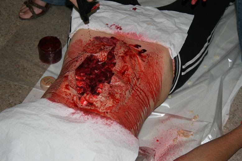 Diabetes In Car Accident Diabetes In Car Accident