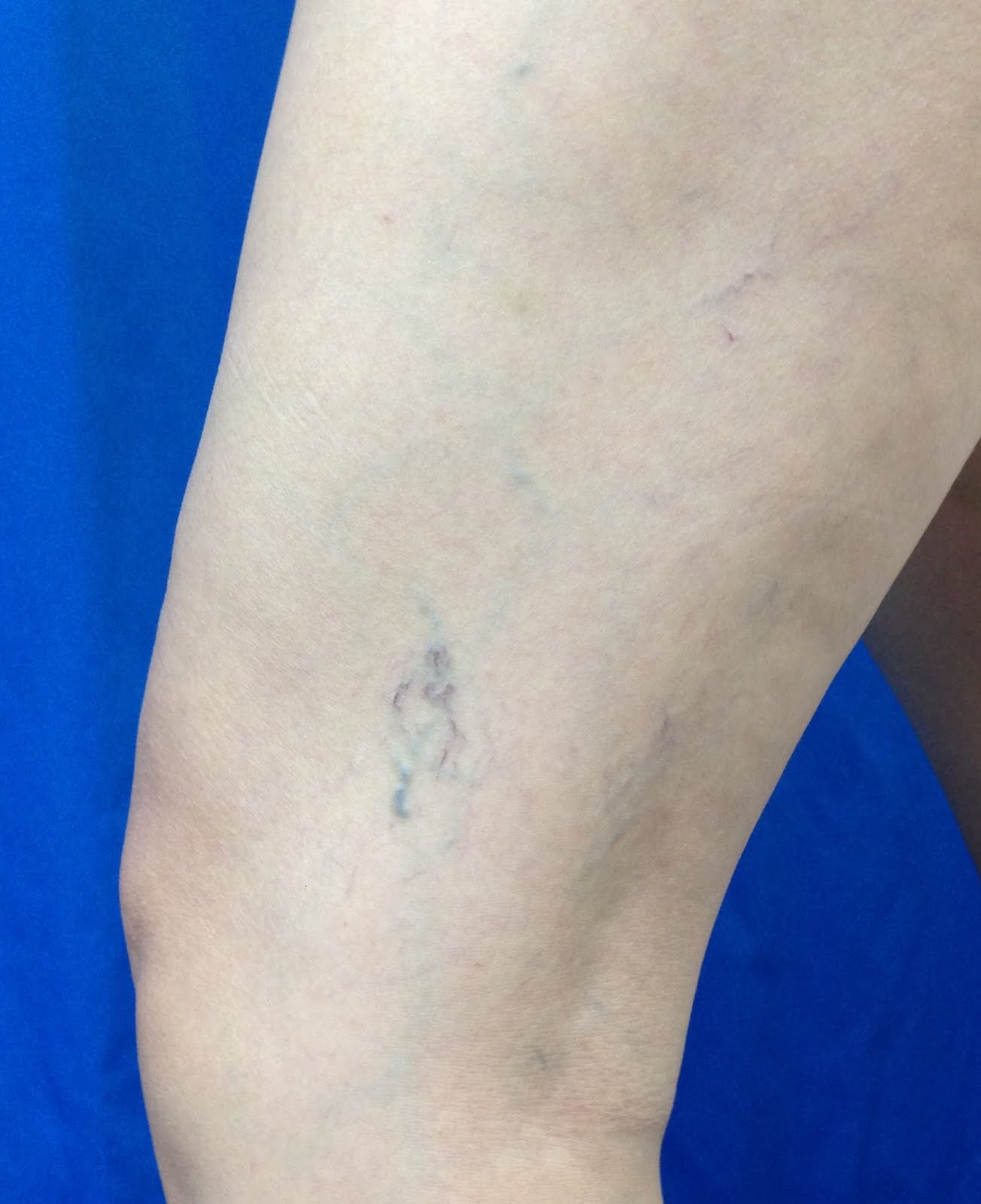 小腿皮膚有明顯的血管發炎發腫發癢之過敏反應 – im5481
