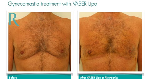 Raloxifene Gynecomastia Before After