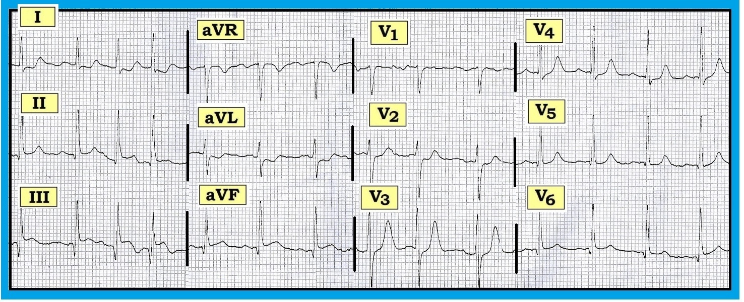 ecg pac