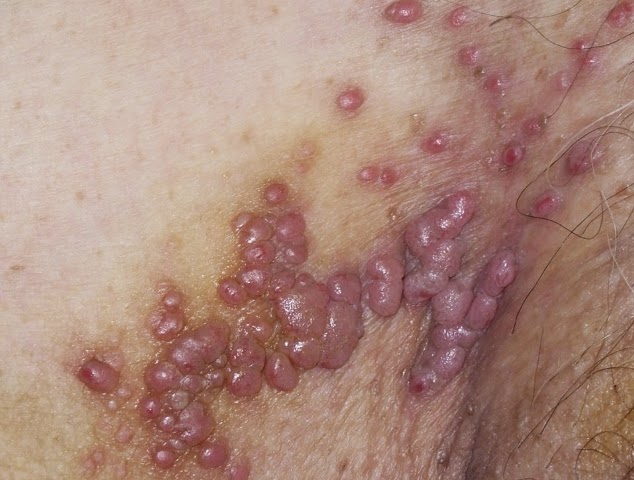 Complete Home Remedy for Genital Herpes part 1