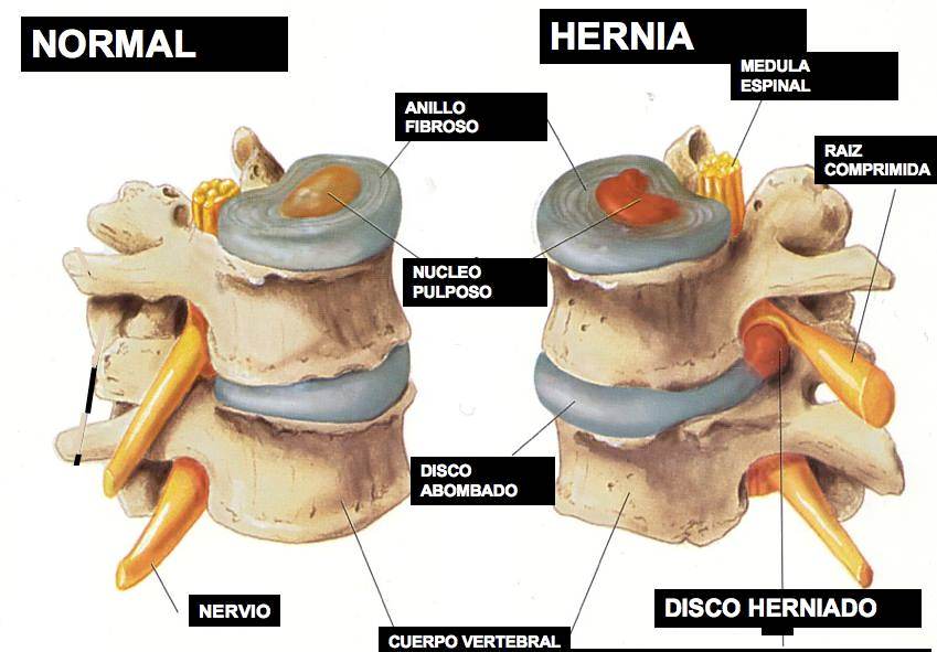 condrosis intervertebral