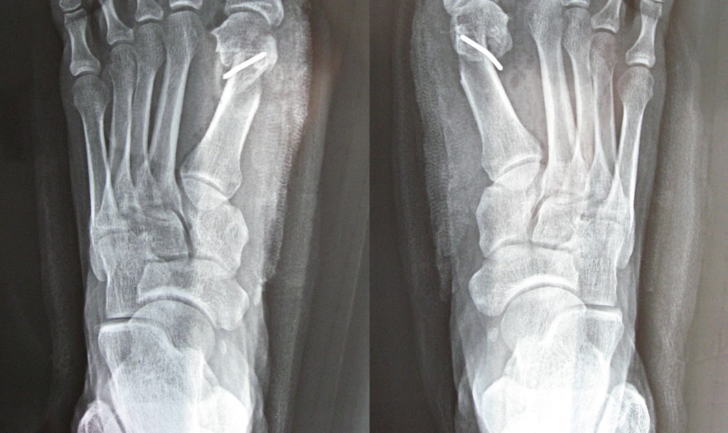 my bunion surgery Xray before Bunionectomy and after