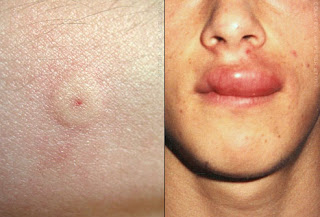 Wasp Sting Allergic reaction
