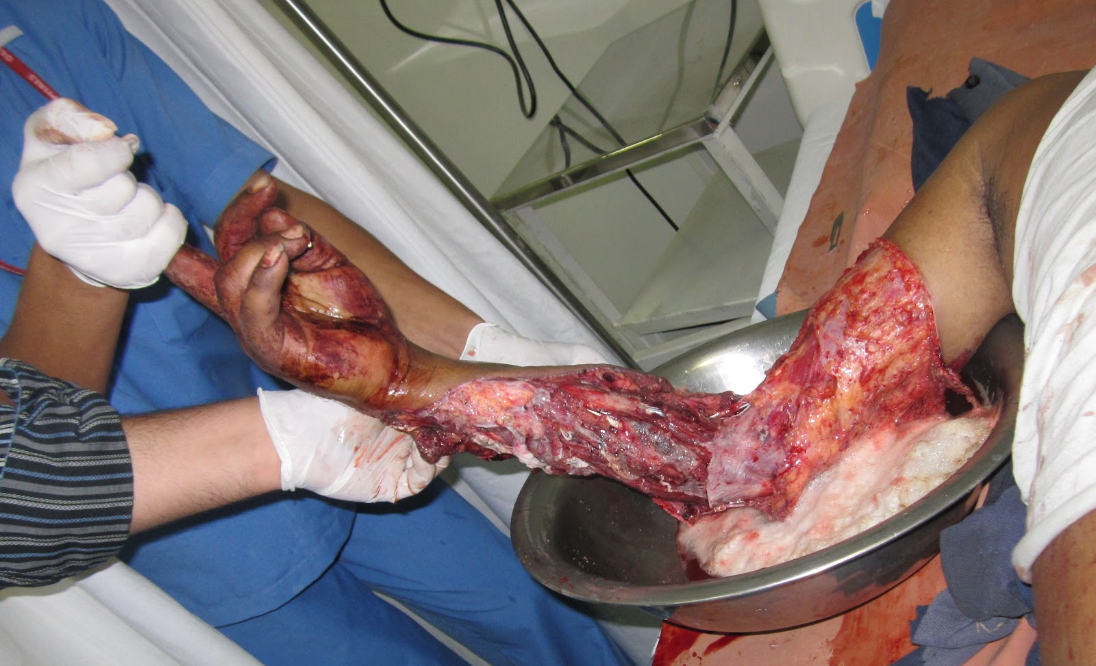 Crush Injuries