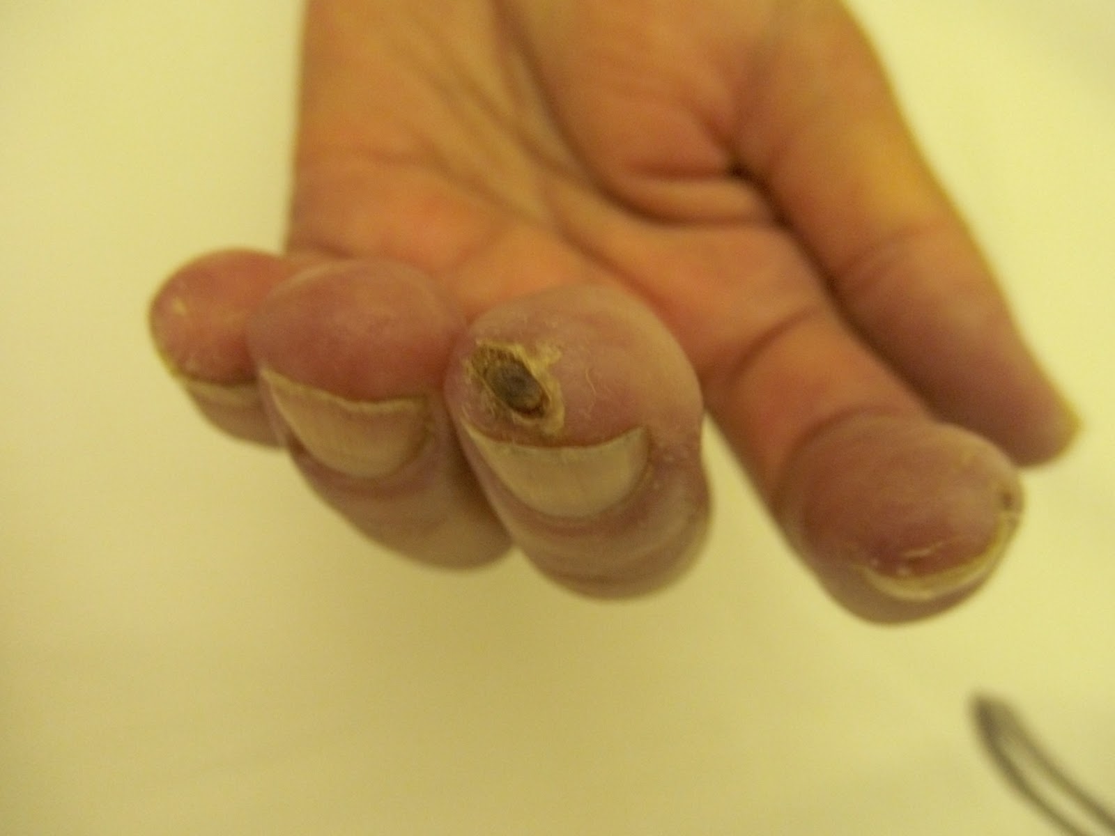 Rheumatologe Scleroderma / Ulcers on fingers