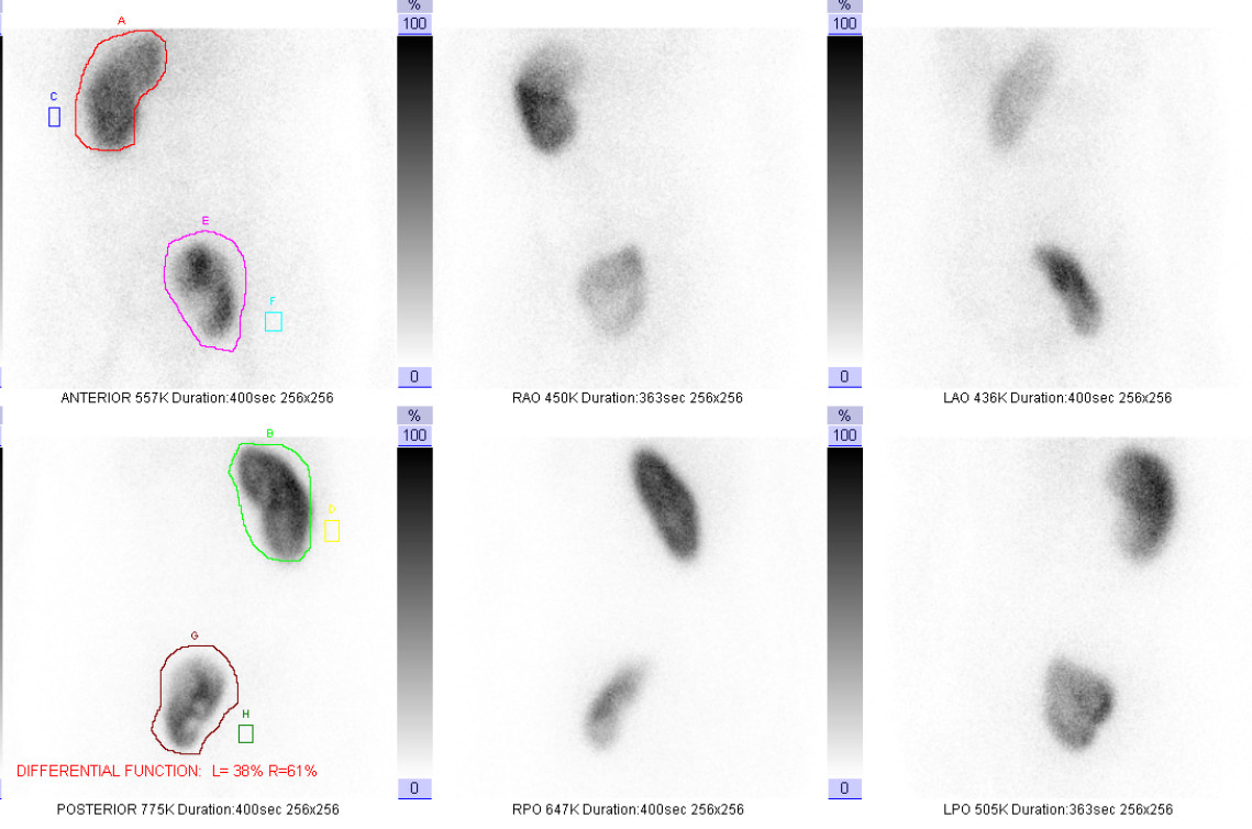 NuCleaR MuNkeE Split Renal Function in a Pelvic Kidney
