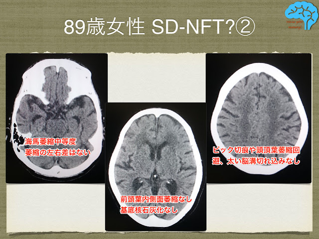 神経原線維変化型老年期認知症(SD-NFT)疑いの頭部CT