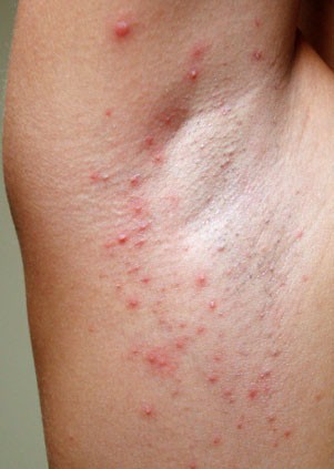 dolor de cuello y hombros