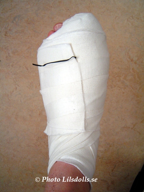 smärta efter hallux valgus operation smärta efter hallux valgus operation