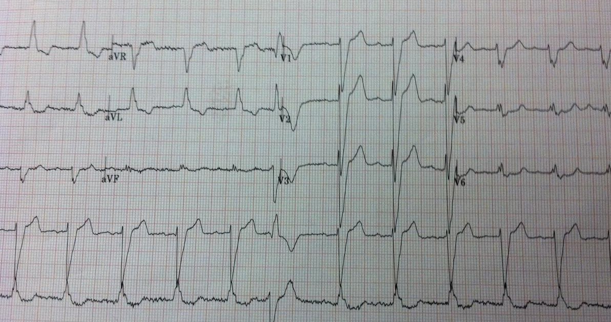Dr. Smith's ECG Blog Left Bundle Branch Block (LBBB) with Chest Pain