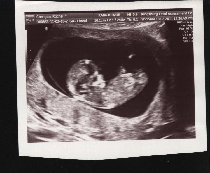 Our Identical Bubbas Our 1st Specialist Scan 11 Weeks 5 Days
