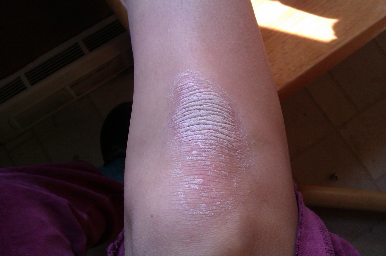 GAPS for Psoriasis Day 16 Psoriasis Update