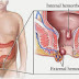 RESEP OBAT WASIR thumbnail