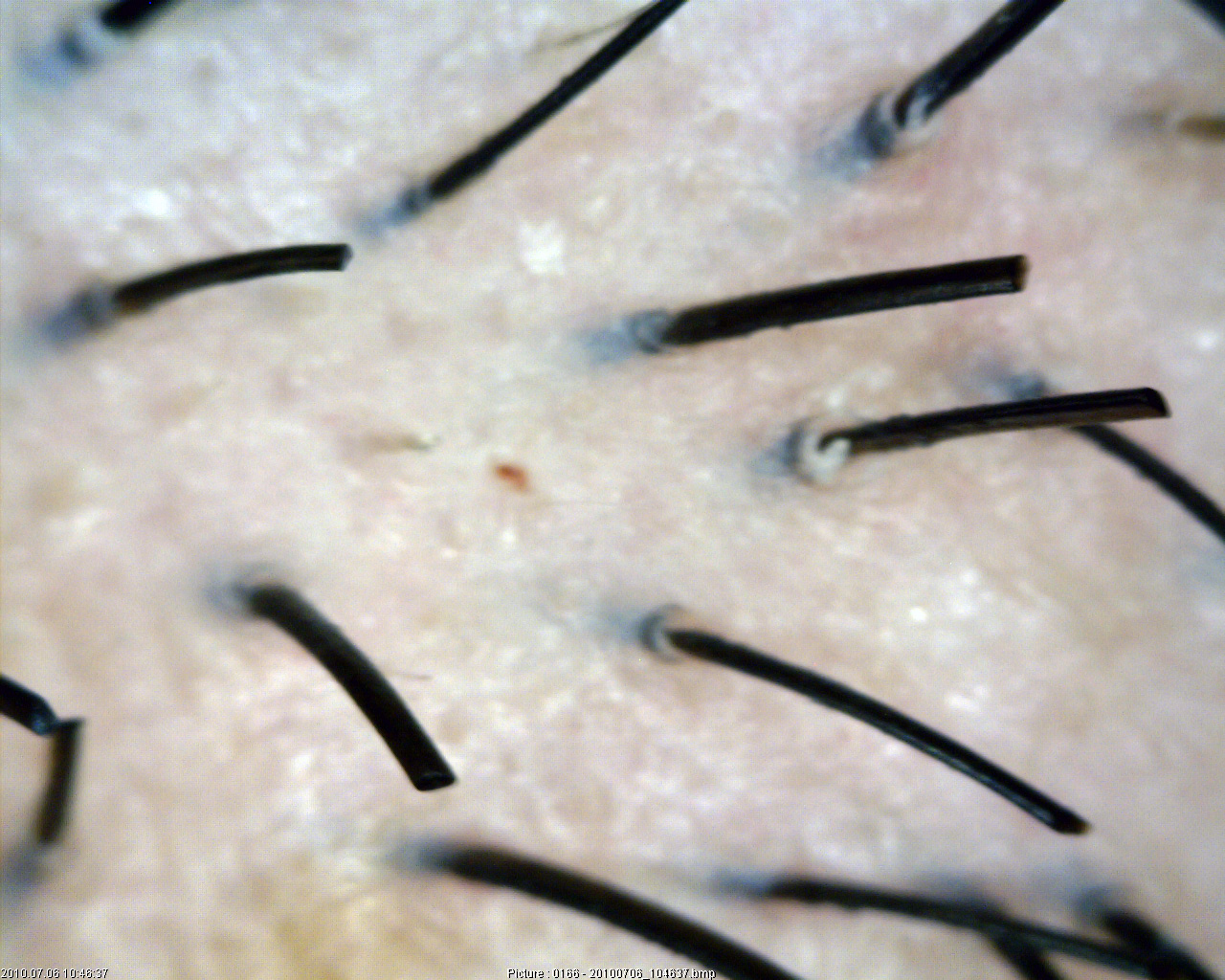 Come togliere un posto di pigmentary su una faccia dopo gravidanza