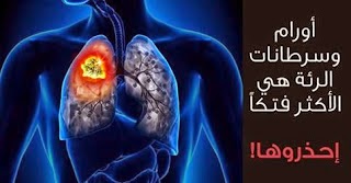 الاورام الخبيثة في الرئة اسبابها وعلاجها والوقاية منها الاورام الخبيثة في الرئة اسبابها وعلاجها والوقاية منها