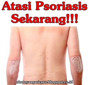 Obat Psoriasis Obat Psoriasis