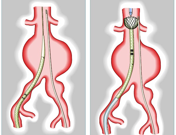 Resultado de imagen para tratamientos endovasculares