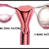 U nang buồng trứng nguyên nhân và cách điều trị