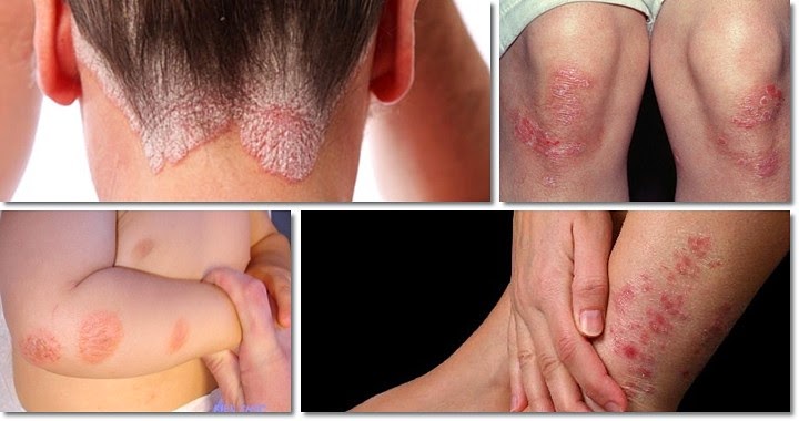 gluten allergi symtom gluten allergi symtom