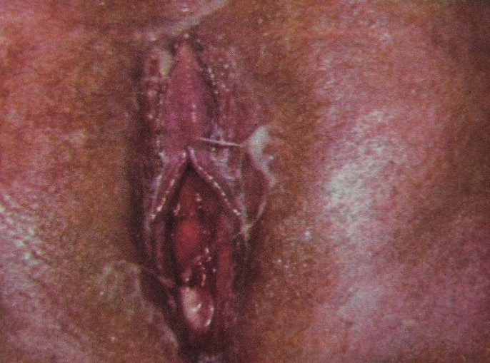 trichomonas vaginalis локализация паразита в организме человека trichomonas vaginalis локализация паразита в организме человека