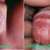 Jual Obat Sipilis Ampuh Alami thumbnail