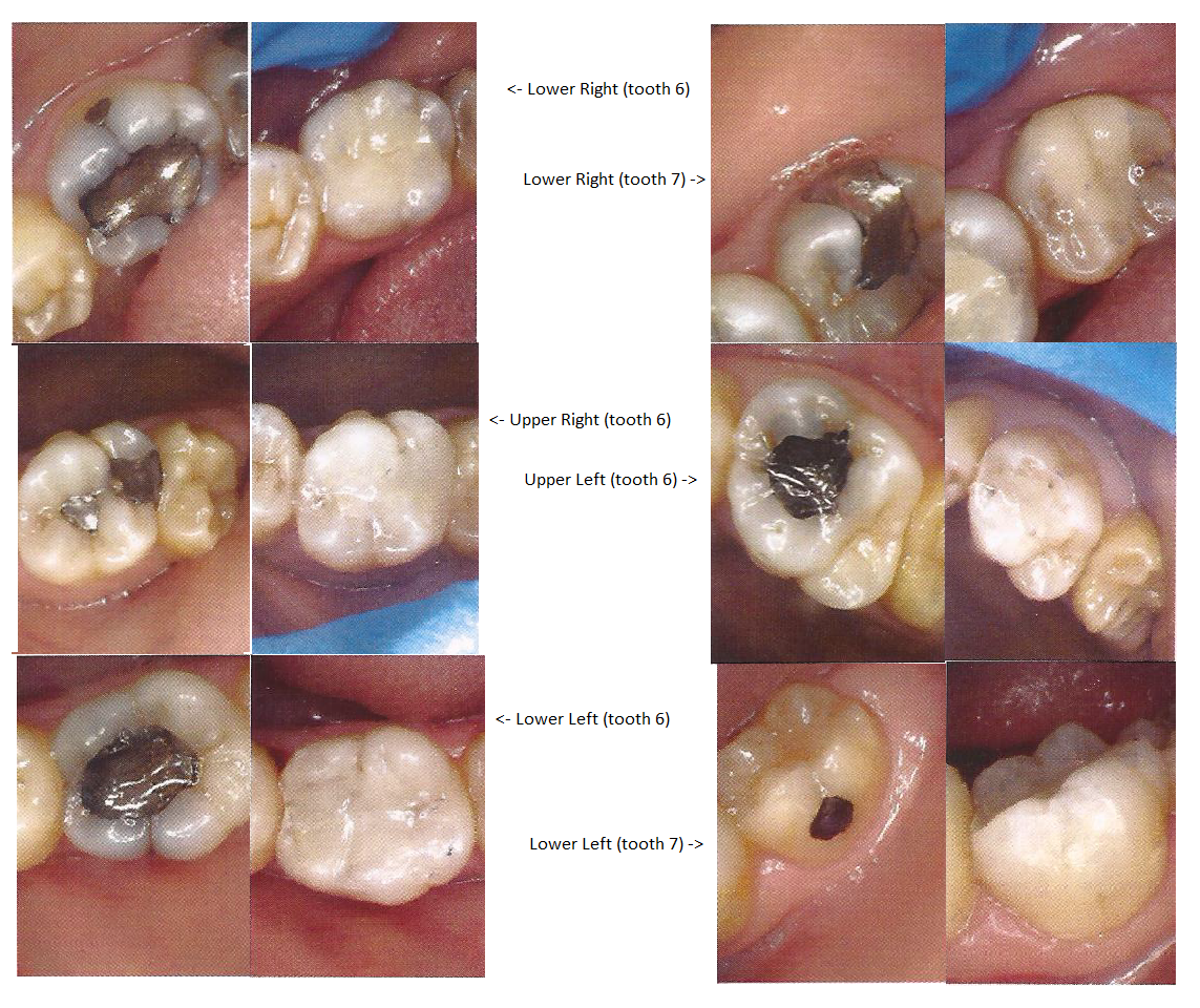 Mercury poisoning from Amalgam fillings April 2013
