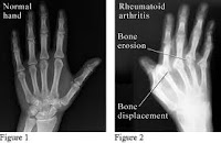 RHEUMATOID ARTHRITIS RHEUMATOID ARTHRITIS