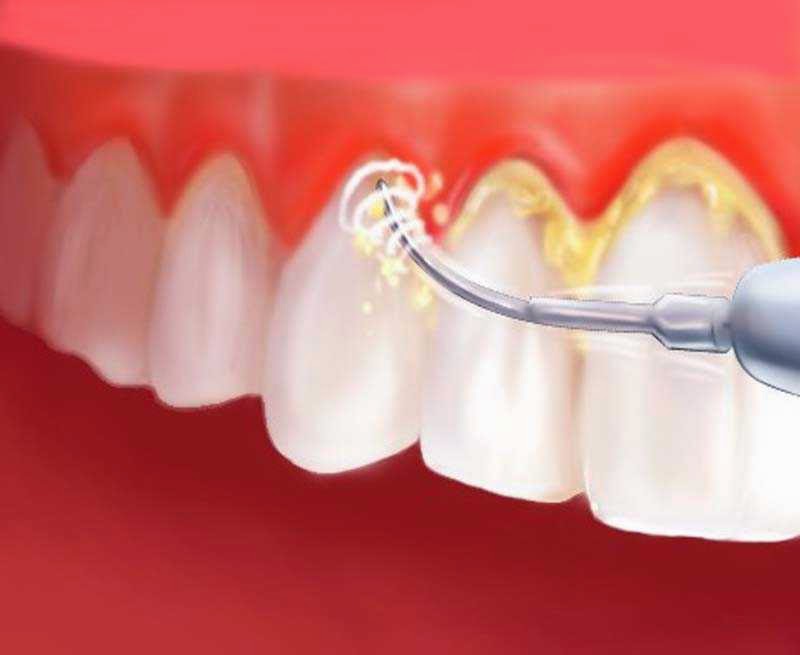 8 Cara Ampuh Menghilangkan Karang Gigi Dokter Gigi