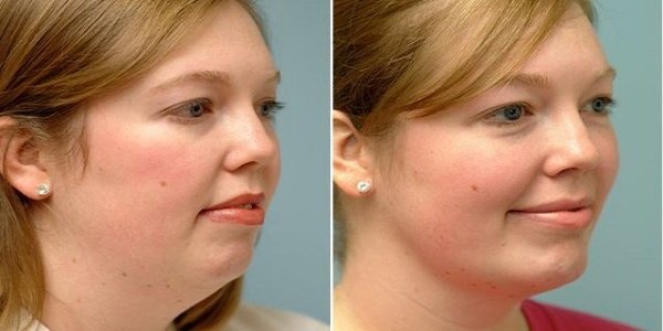Incredible Exercises to Tighten Up Your Loose Skin and Lose Double Chin Double Chin - BEFORE AND AFTER