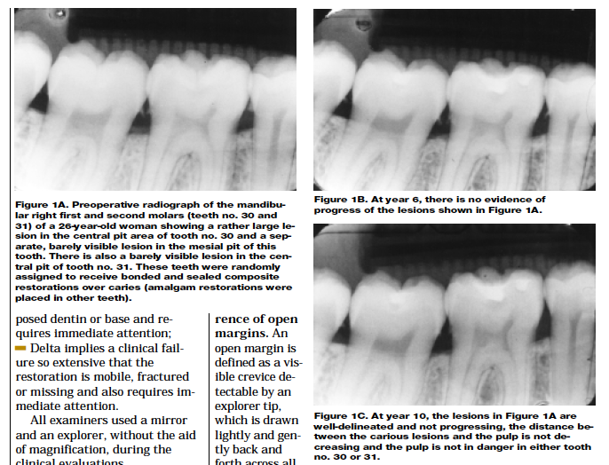 OD奉行捕物帳 How to Manage Large Decay Tooth without Pulpal Symptoms I