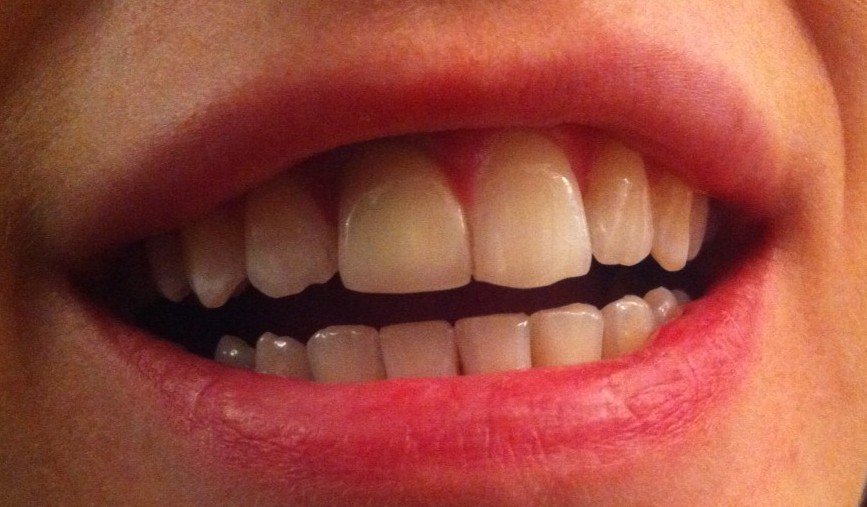 invisalign attachments removed week aligner result