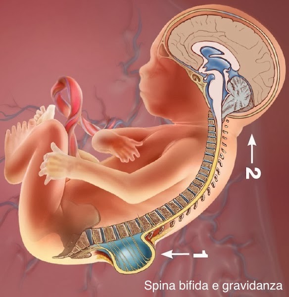 Hydrocephalus in adults life expectancy