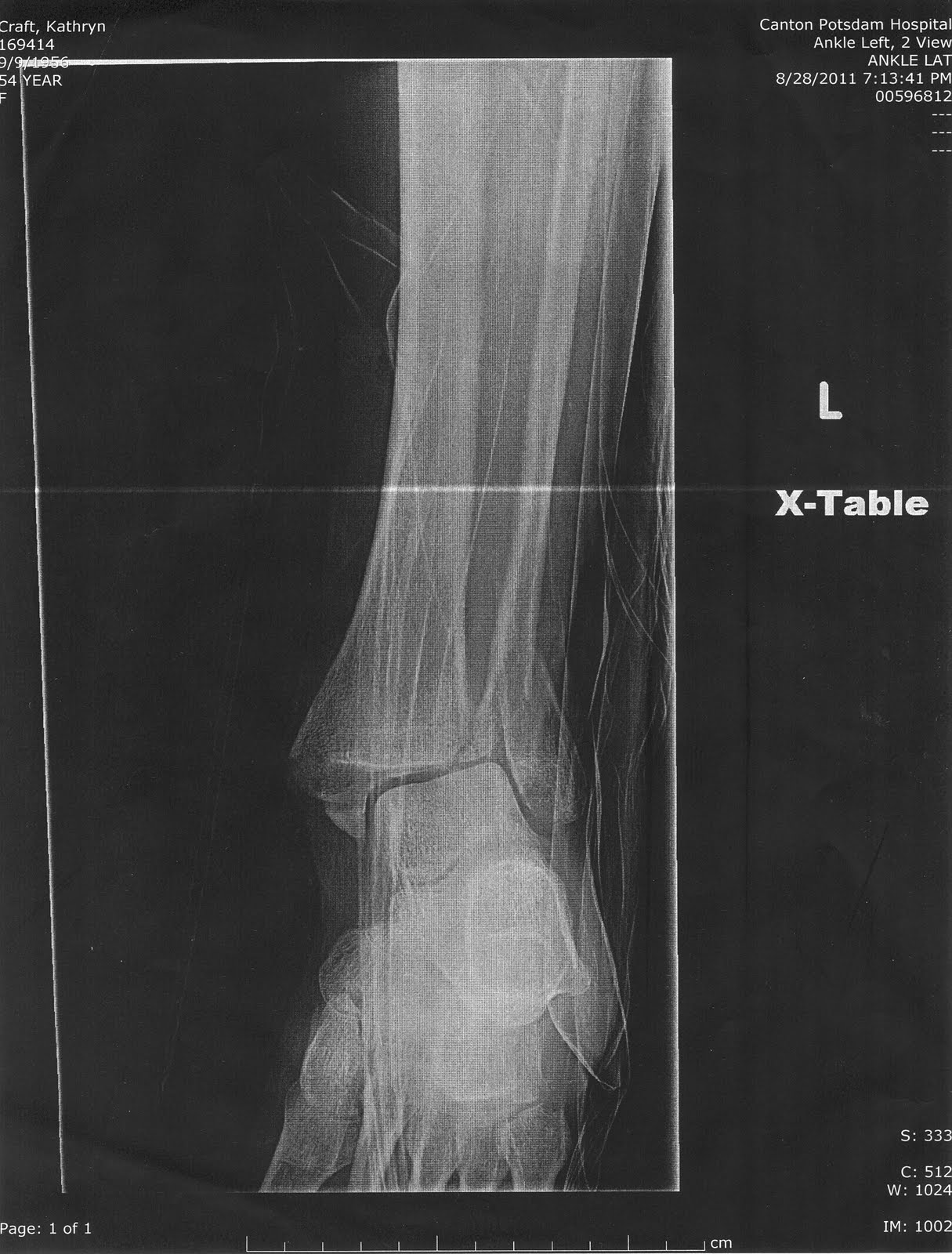 Ankle fracture healing image