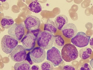 DE CITOGENETICA DE LEUCEMIA MIELOIDE de citogenetica de leucemia mieloide: