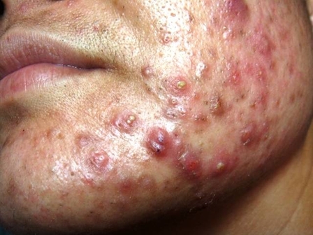 Cystic acne from steroids