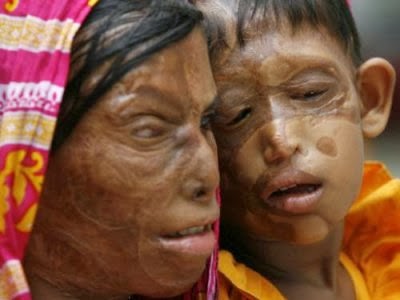 Burn Victim Meaning | conspiracy of hope november 2013 Burn Victim Meaning | conspiracy of hope november 2013