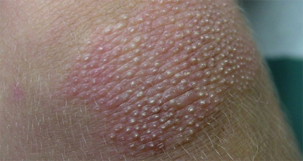 Le programme de la santé avec elenoj malychevoj sur le psoriasis