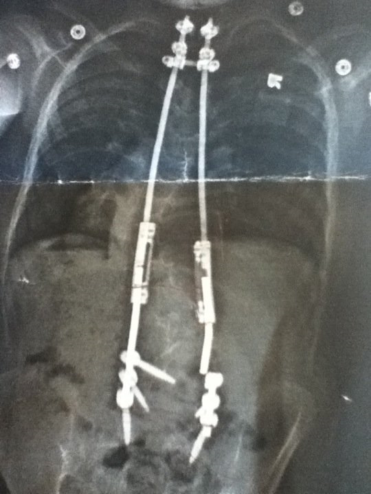 Life with Beals Surgical Options